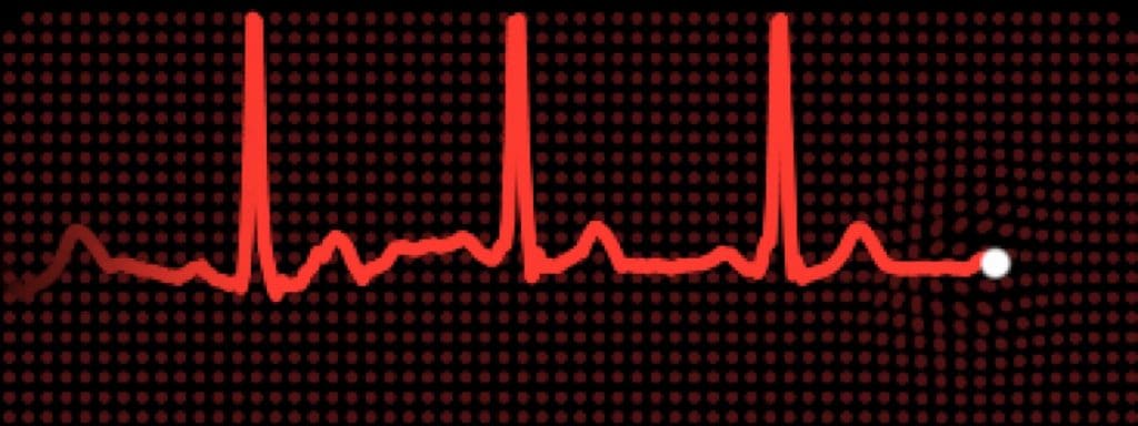 An ECG on an Apple Watch